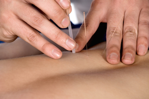 Acupuncture at Woolpit Complementary