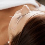 Facial Acupuncture at Woolpit Complementary