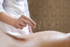 traditional acupuncture - woolpit complementary