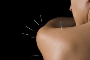 Acupuncture - Shoulder